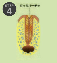 虫歯治療2-4
