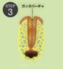 虫歯治療3-3