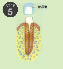 虫歯治療3-5